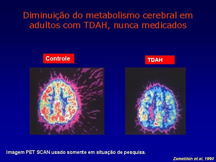 Diminuição do metabolismo cerebral em adultos com TDAH, nunca medicados Controle TDAH Imagem PET