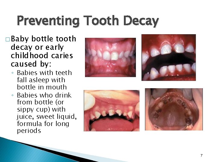 Preventing Tooth Decay � Baby bottle tooth decay or early childhood caries caused by: