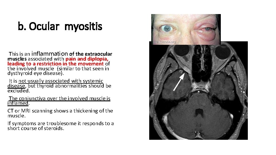 b. Ocular myositis This is an inflammation of the extraocular muscles associated with pain