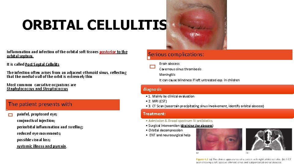 ORBITAL CELLULITIS Inflammation and infection of the orbital soft tissues posterior to the orbital