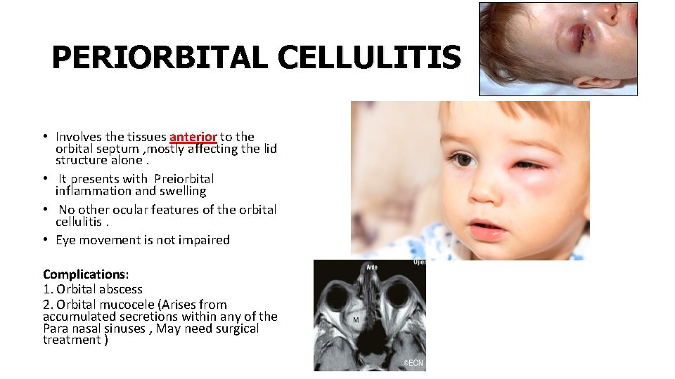 PERIORBITAL CELLULITIS • Involves the tissues anterior to the orbital septum , mostly affecting