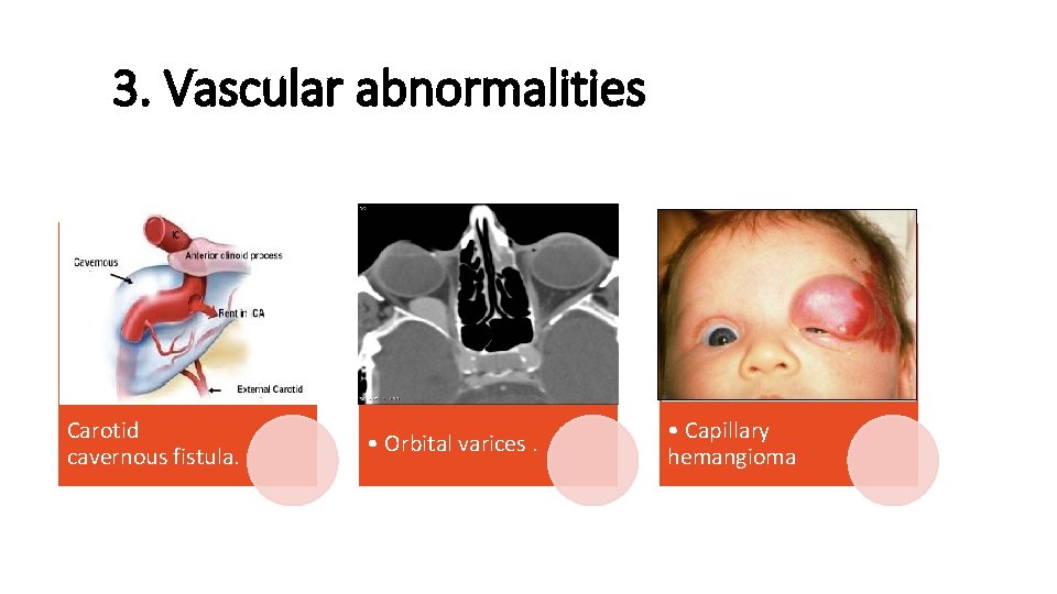 3. Vascular abnormalities Carotid cavernous fistula. • Orbital varices. • Capillary hemangioma 