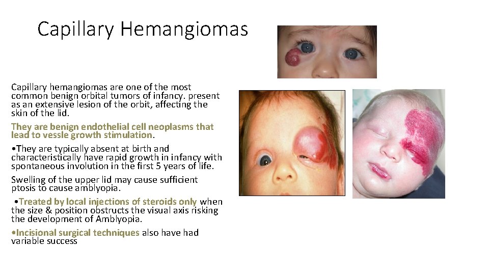 Capillary Hemangiomas Capillary hemangiomas are one of the most common benign orbital tumors of