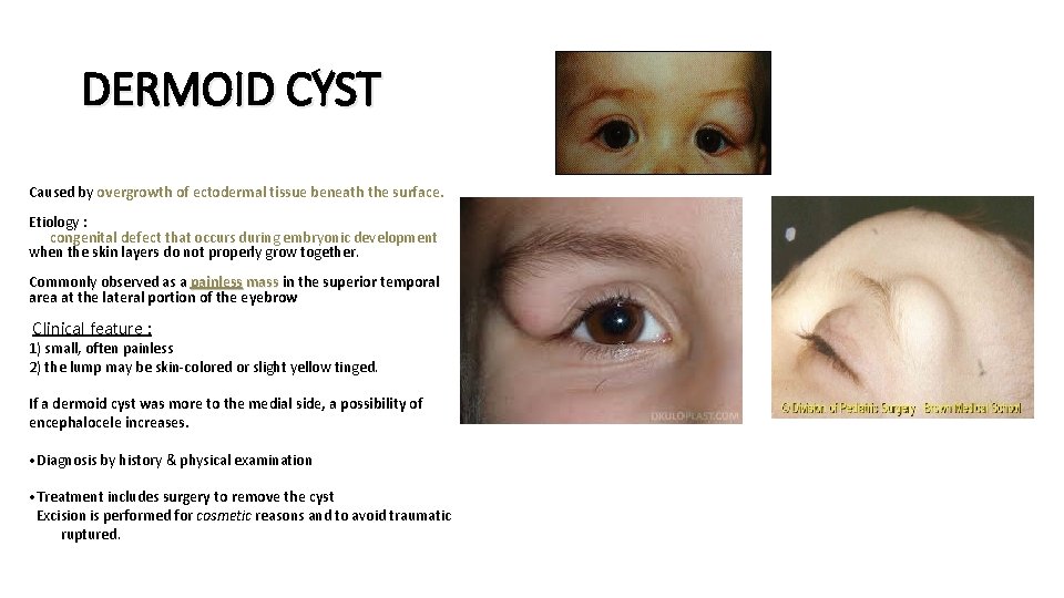 DERMOID CYST Caused by overgrowth of ectodermal tissue beneath the surface. Etiology : congenital