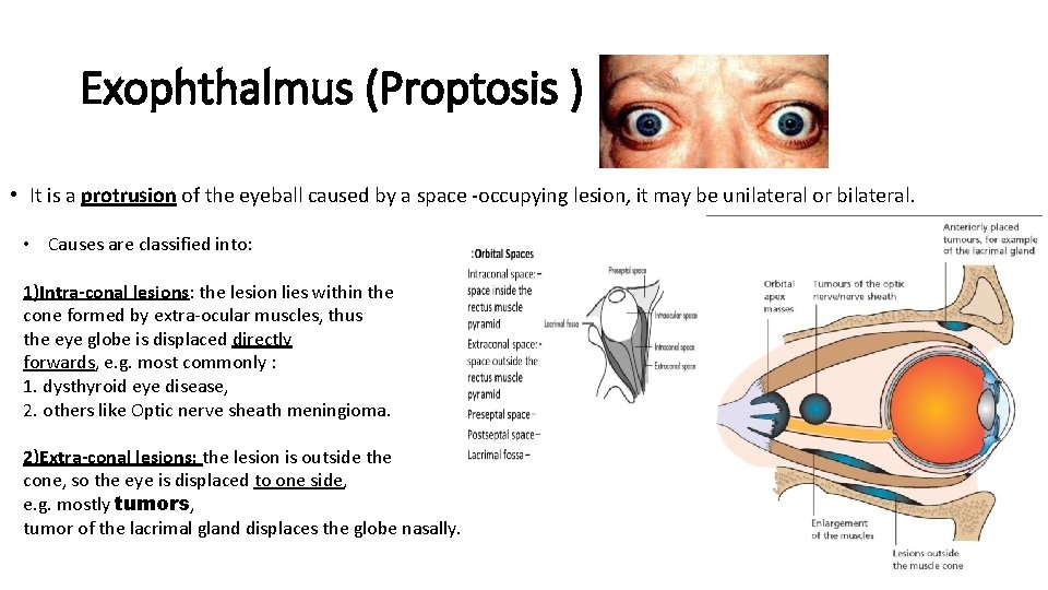 Exophthalmus (Proptosis ) • It is a protrusion of the eyeball caused by a