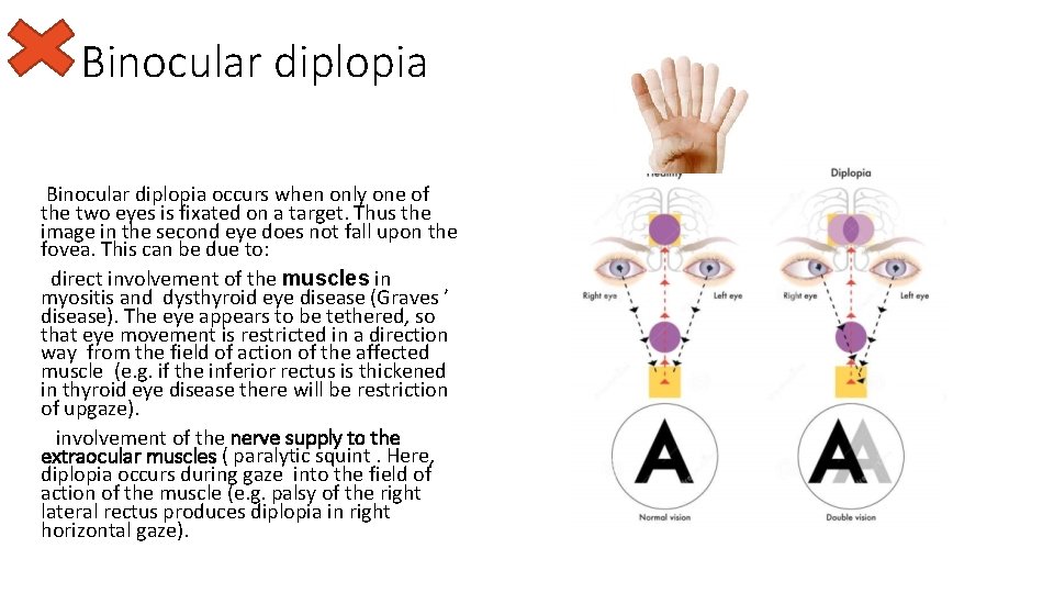 Binocular diplopia occurs when only one of the two eyes is fixated on a