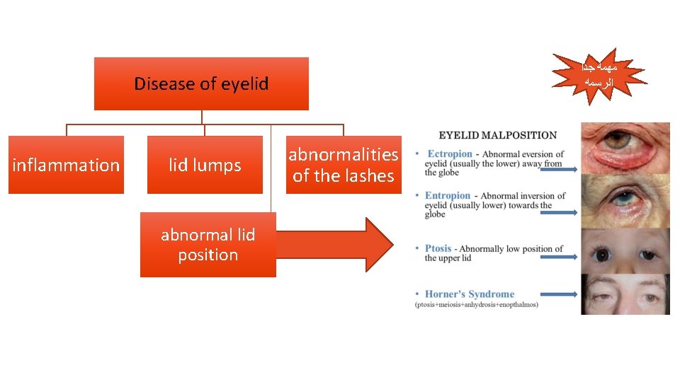  ﻣﻬﻤﻪ ﺟﺪﺍ ﺍﻟﺮﺳﻤﻪ Disease of eyelid inflammation lid lumps abnormal lid position abnormalities