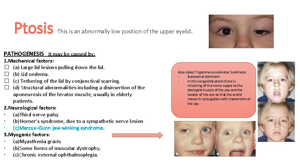Ptosis This is an abnormally low position of the upper eyelid. PATHOGENESIS It may
