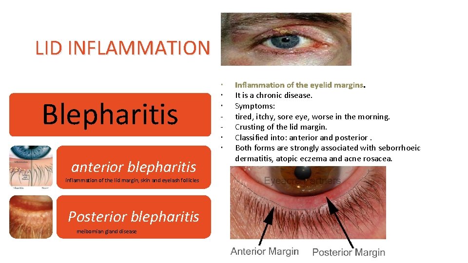 LID INFLAMMATION Blepharitis anterior blepharitis inflammation of the lid margin, skin and eyelash follicles