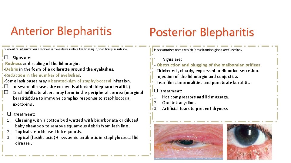 Anterior Blepharitis Posterior Blepharitis Is when the inflammation is located in the outside surface