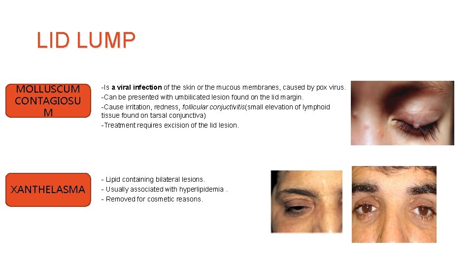 LID LUMP MOLLUSCUM CONTAGIOSU M XANTHELASMA -Is a viral infection of the skin or