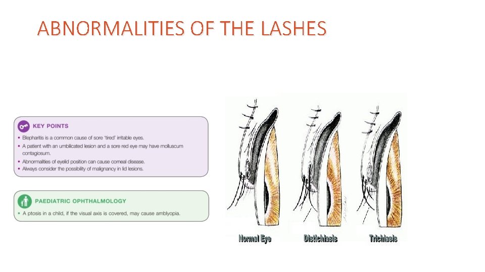 ABNORMALITIES OF THE LASHES 