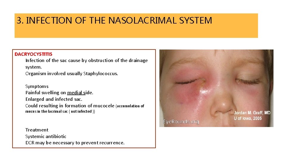 3. INFECTION OF THE NASOLACRIMAL SYSTEM DACRYOCYSTITIS Infection of the sac cause by obstruction