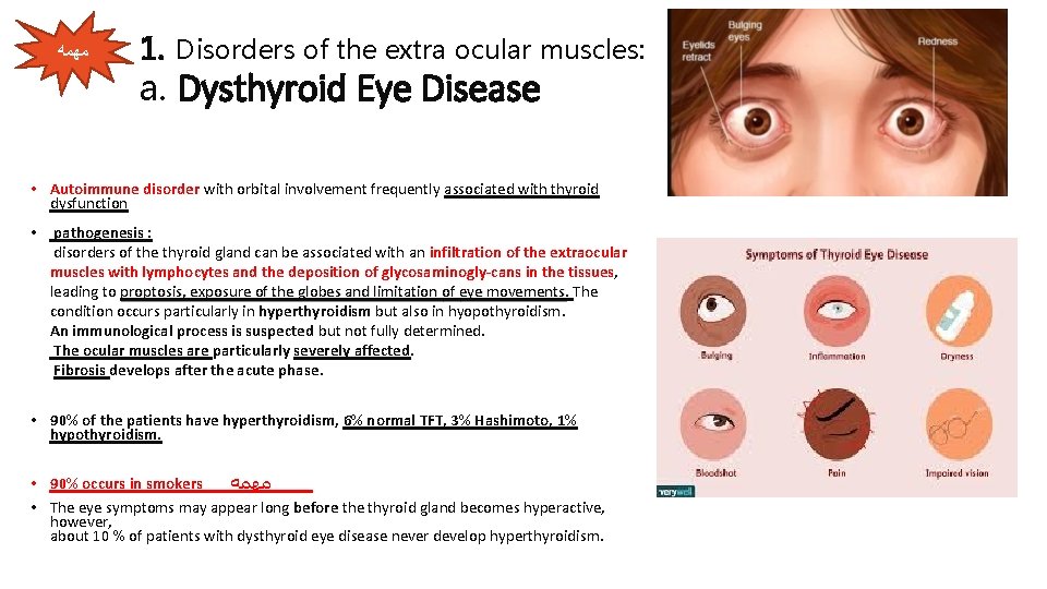  ﻣﻬﻤﻪ 1. Disorders of the extra ocular muscles: a. Dysthyroid Eye Disease •