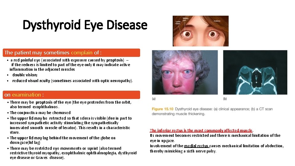 Dysthyroid Eye Disease The patient may sometimes complain of : • a red painful