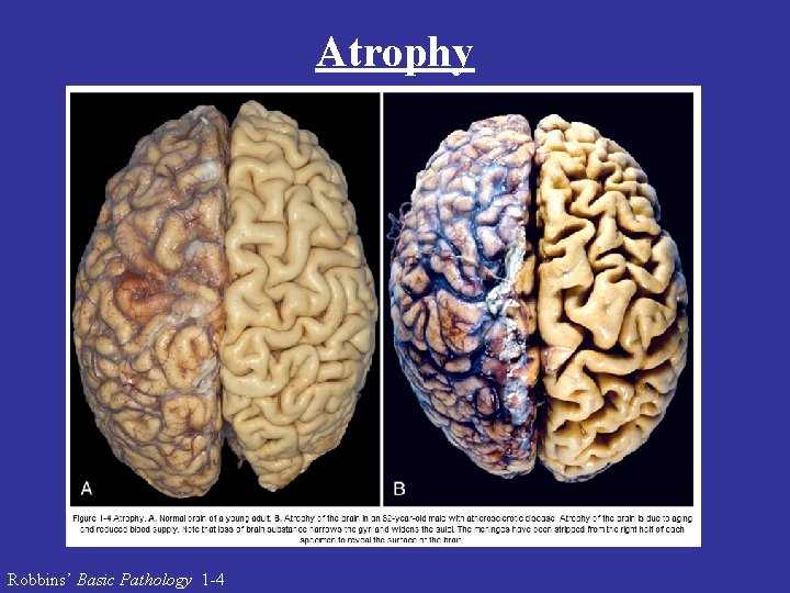 Atrophy Robbins’ Basic Pathology 1 -4 