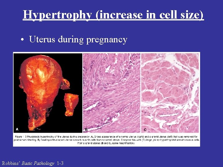 Hypertrophy (increase in cell size) • Uterus during pregnancy Robbins’ Basic Pathology 1 -3