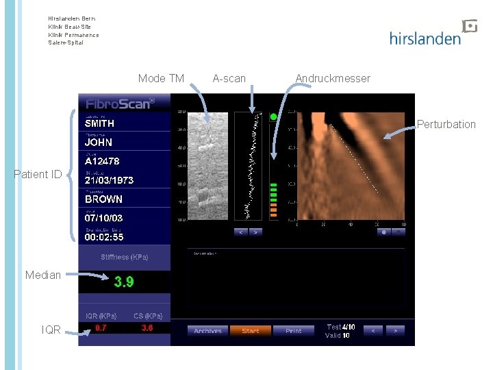 Hirslanden Bern Klinik Beau-Site Klinik Permanence Salem-Spital Mode TM A-scan Andruckmesser Perturbation Patient ID