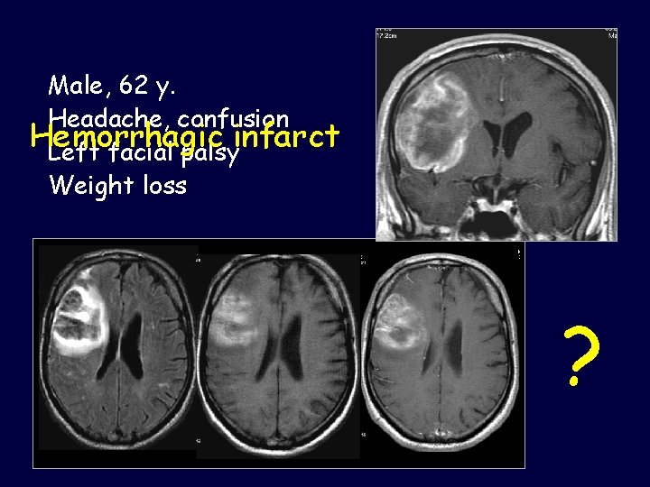 Male, 62 y. Headache, confusion Hemorrhagic infarct Left facial palsy Weight loss ? 