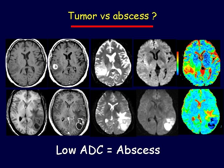 Tumor vs abscess ? Low ADC = Abscess 