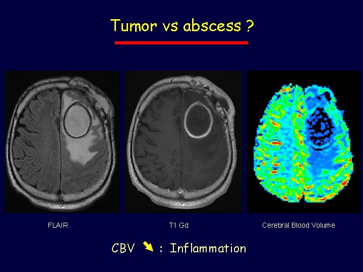 Tumor vs abscess ? FLAIR T 1 Gd CBV : Inflammation Cerebral Blood Volume