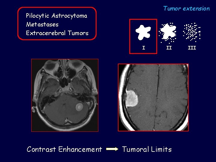 Tumor extension Pilocytic Astrocytoma Metastases Extracerebral Tumors I Contrast Enhancement II Tumoral Limits III
