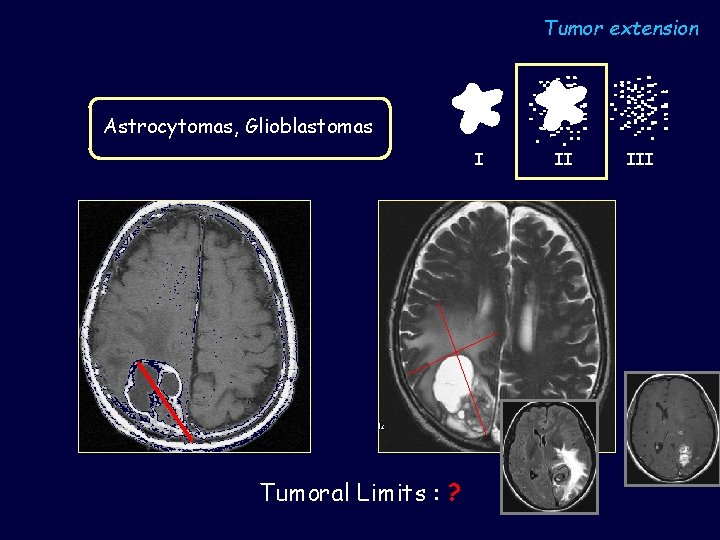Tumor extension Astrocytomas, Glioblastomas I Tumoral Limits : ? II III 