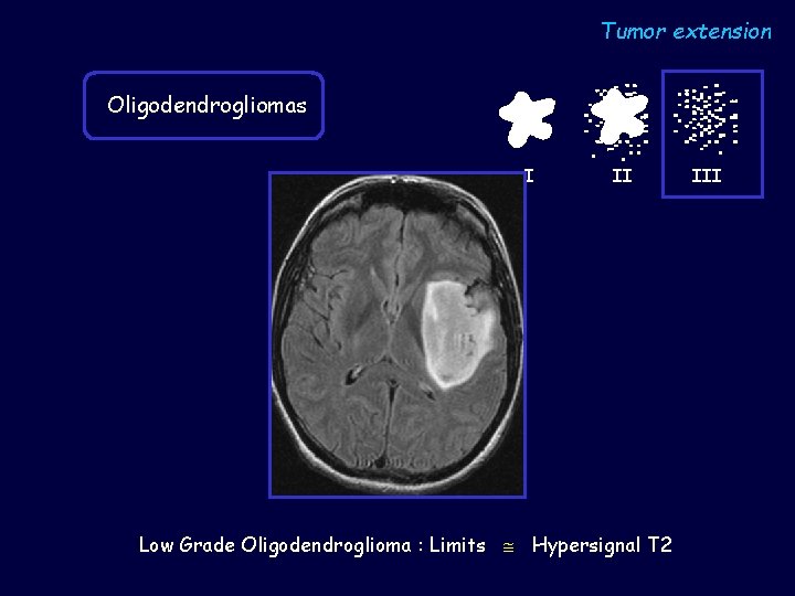Tumor extension Oligodendrogliomas I II Low Grade Oligodendroglioma : Limits Hypersignal T 2 III