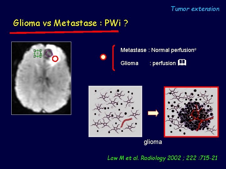 Tumor extension Glioma vs Metastase : PWi ? Metastase : Normal perfusione Glioma :