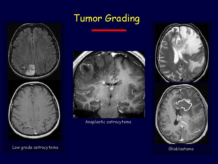 Tumor Grading Anaplastic astrocytoma Low grade astrocytoma Glioblastoma 
