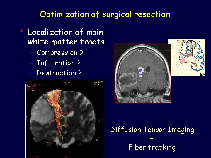 Optimization of surgical resection • Localization of main white matter tracts – Compression ?