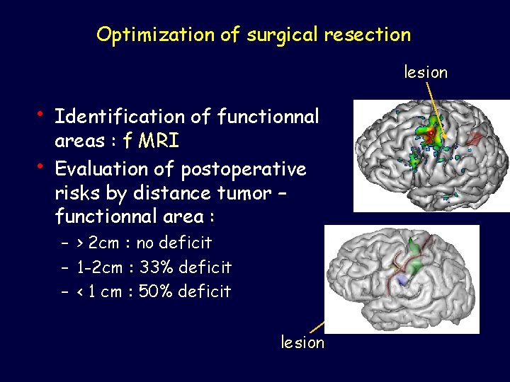Optimization of surgical resection lesion • • Identification of functionnal areas : f MRI