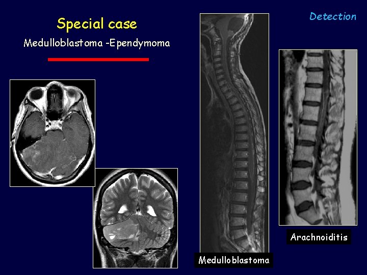Detection Special case Medulloblastoma -Ependymoma Arachnoiditis Medulloblastoma 