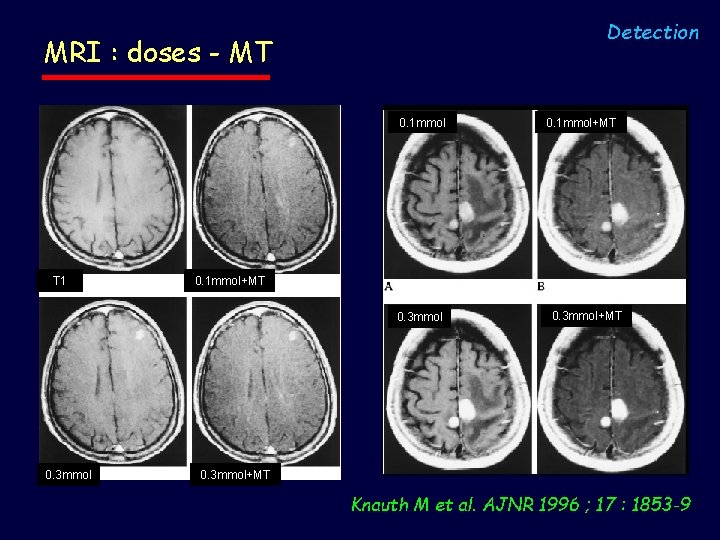 Detection MRI : doses - MT 0. 1 mmol T 1 0. 1 mmol+MT