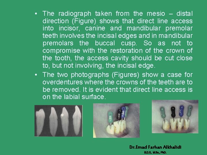  • The radiograph taken from the mesio – distal direction (Figure) shows that