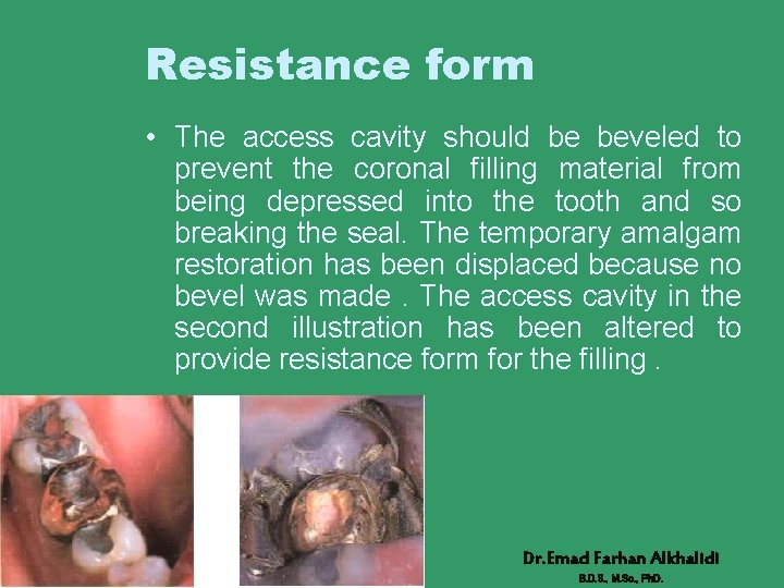 Resistance form • The access cavity should be beveled to prevent the coronal filling