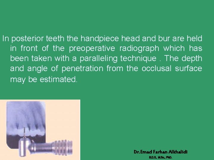In posterior teeth the handpiece head and bur are held in front of the