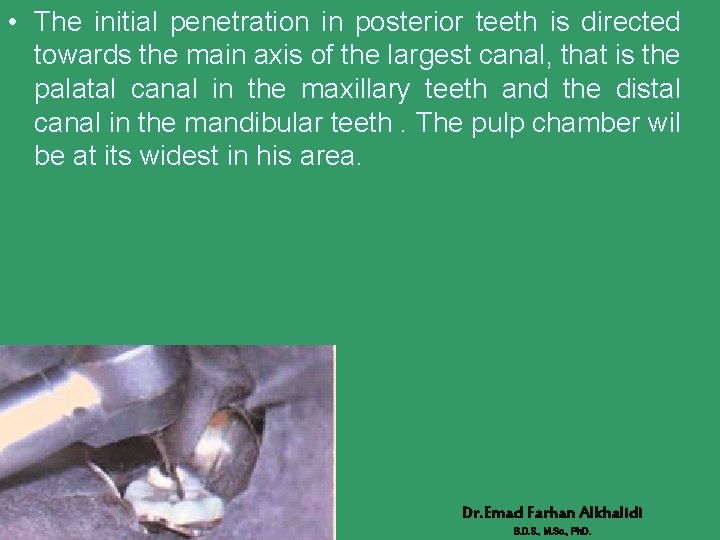  • The initial penetration in posterior teeth is directed towards the main axis