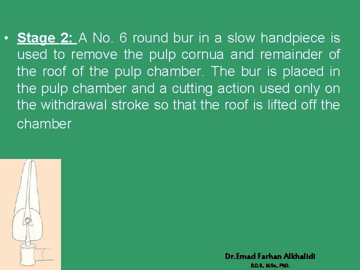  • Stage 2: A No. 6 round bur in a slow handpiece is