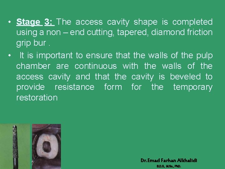  • Stage 3: The access cavity shape is completed using a non –