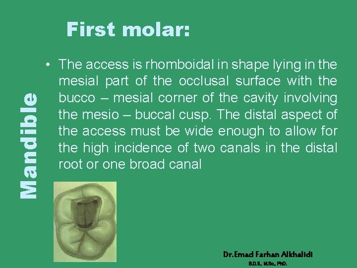 Mandible First molar: • The access is rhomboidal in shape lying in the mesial