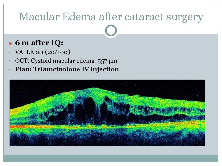 Macular Edema after cataract surgery ● 6 m after IQ: • VA LE 0.