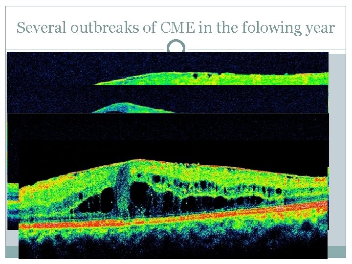 Several outbreaks of CME in the folowing year 