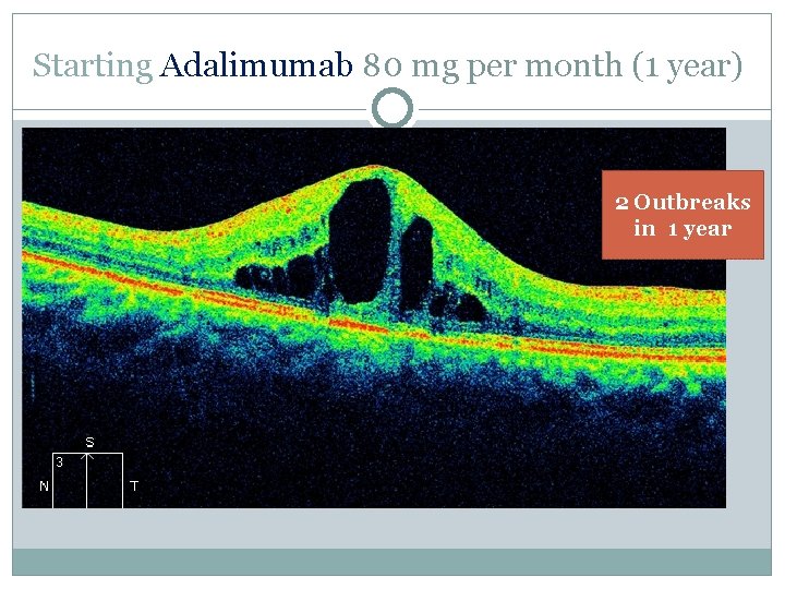 Starting Adalimumab 80 mg per month (1 year) 2 Outbreaks in 1 year 