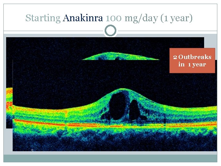 Starting Anakinra 100 mg/day (1 year) 2 Outbreaks in 1 year 