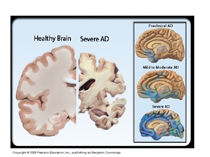 Alzheimer’s Disease (AD) Copyright © 2006 Pearson Education, Inc. , publishing as Benjamin Cummings