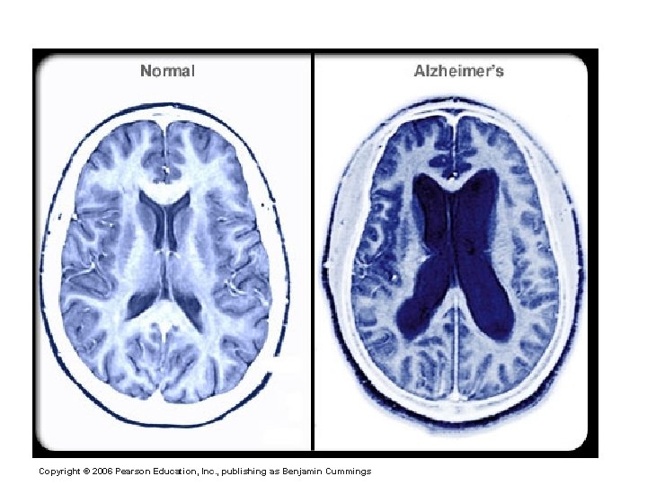Alzheimer’s Disease (AD) Copyright © 2006 Pearson Education, Inc. , publishing as Benjamin Cummings