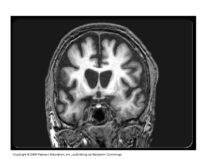 Huntington’s Disease Copyright © 2006 Pearson Education, Inc. , publishing as Benjamin Cummings 