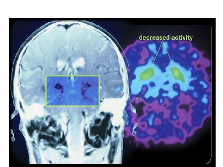 Parkinson’s Disease Copyright © 2006 Pearson Education, Inc. , publishing as Benjamin Cummings 