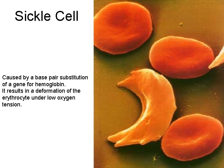 Sickle Cell Caused by a base pair substitution of a gene for hemoglobin. It